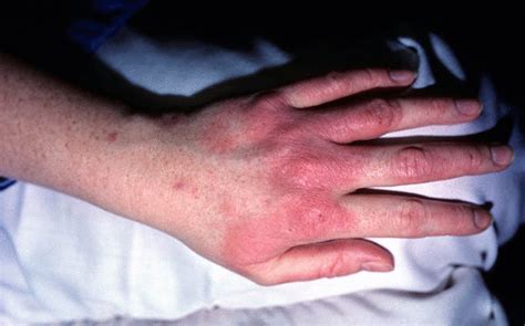 Actively Seedling Policy Hand Dermatitis Cream Dislocation Dilemma Boundary