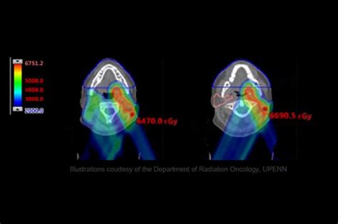 Treating Head And Neck Cancer With Proton Therapy Iba Campus