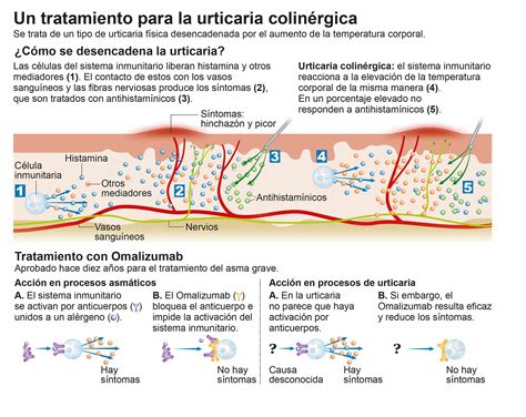 Infográfico Tratamiento Con Omalizumab De La Urticaria Colinérgica