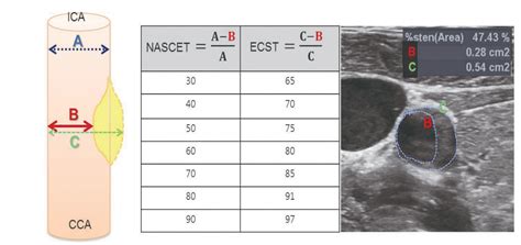 Carotid Ultrasound Imaging And Interpretation For Clinicians