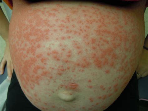 Herpes gestationis: sintomi, terapia ed immagini per ...