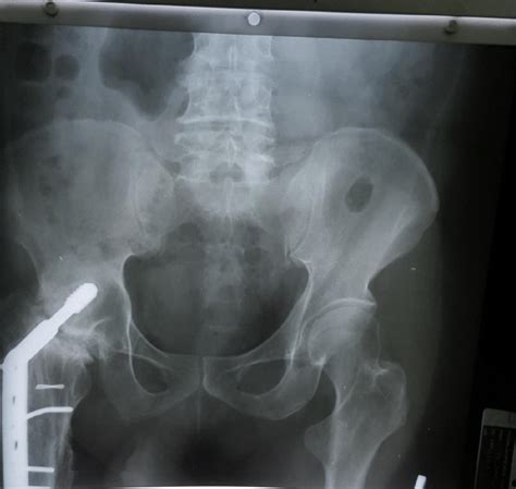 Post Operative Radiograph Of Pelvis And Both Hip Joints Download