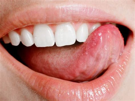 Dysphagia Therapy Tongue Exercises Canker Sore Tongue Sores