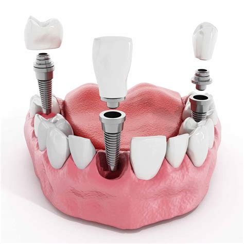 The Truth About Dental Implants Why They Might Not Be Suitable For You
