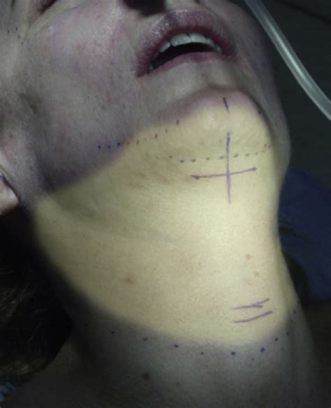 Short Scar Neck Lift Clinics In Plastic Surgery