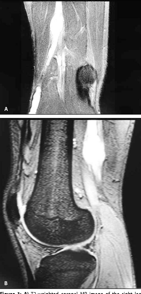 Figure 1 From Pure Peroneal Intraneural Ganglion Cyst Ascending Along