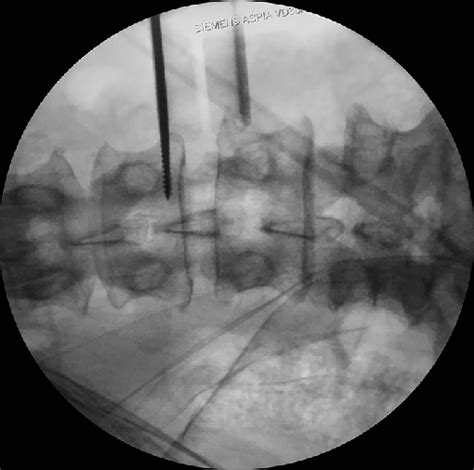 Ap Intraoperative Fluoroscopic Image Retractors Blade Is Fixed With