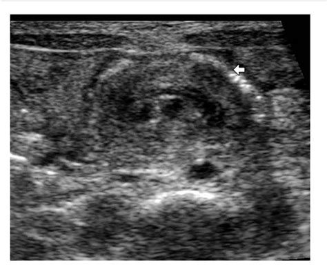 Figure 1 From Ultrasound “whirlpool Sign” For Midgut Volvulus