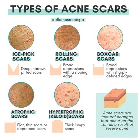 Different Types Of Acne Scars