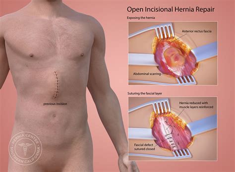 Incisional Hernia Repair Procedure Description Mymeditravel Knowledge