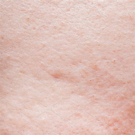 Human Face Skin Texture Featuring Abstract Acne And Background