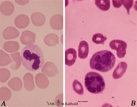 Band And Hypersegmented Neutrophils In Peripheral Blood Smear Human