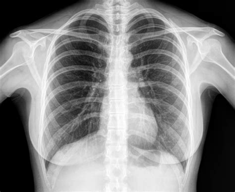 Xray Of Chest Doctors Answer Your Questions