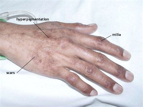 Typical Skin Disease In Porphyria Cutanea Tarda And Variegate Porphyria