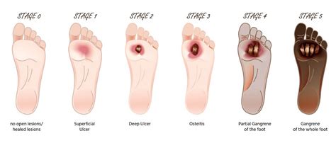 Diabetic Foot Ulcer Stages