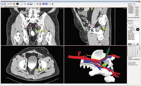 Association Of Image Guided Navigation With Complete Resection Rate In