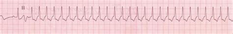 It involves a fast, irregular heartbeat that starts and stops abruptly. A very short guide to ECG interpretation | Blog of Dr. Agnibho