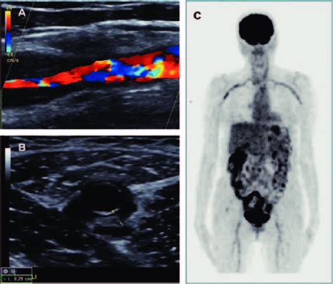 Typical Vascular Fi Ndings In Extracranial Gca Panel A Duplex Scan Of