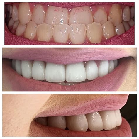 Worst Veneers Before And After General Info