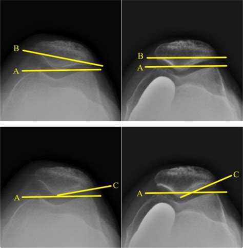 Lateral Retinacular Release During Medial Unicompartmental Knee