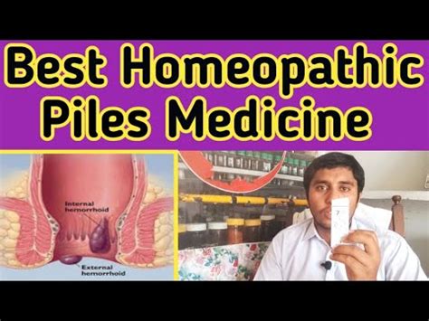 Best Homeopathy Medicine For Piles Hemorrhoids Kl Homeopathy
