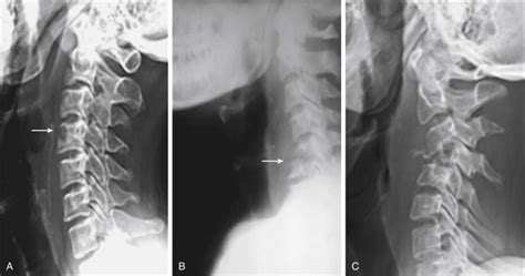 Tuberculosis Of The Cervical Spine Musculoskeletal Key