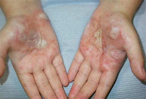hand eczema hand dermatitis