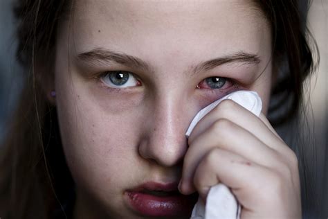 Viral Pink Eye: Symptoms, Treatment, and Prevention | eyeSTYLE blog