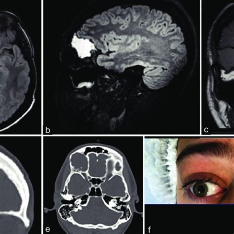 A Skull X Ray Showing Bony Erosion B Ct Brain Showing Inner Table