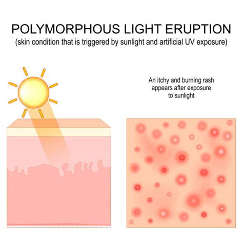 Polymorphic Light Eruption Stock Photos Pictures And Royalty Free Images