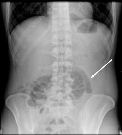 Cureus Abdominal Cocoon Syndrome A Rare Cause Of Intestinal Obstruction