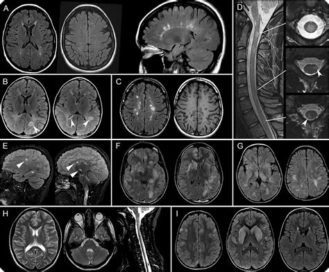 Brain mri scan showing white lesions associated with multiple sclerosis. MRI in the evaluation of pediatric multiple sclerosis ...