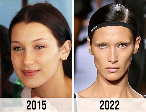 fans think bella hadid had fat removal surgery after seeing old pictures