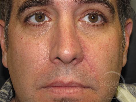 Nose Reconstruction 2 Skin Cancer And Reconstructive Surgery Center