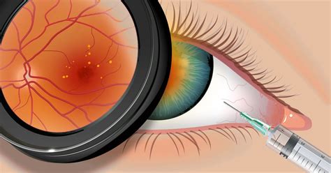 Intravitreal Eye Injection An Innovative Amd Treatment