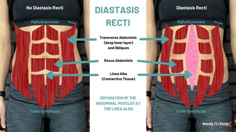 What Is Diastasis Recti