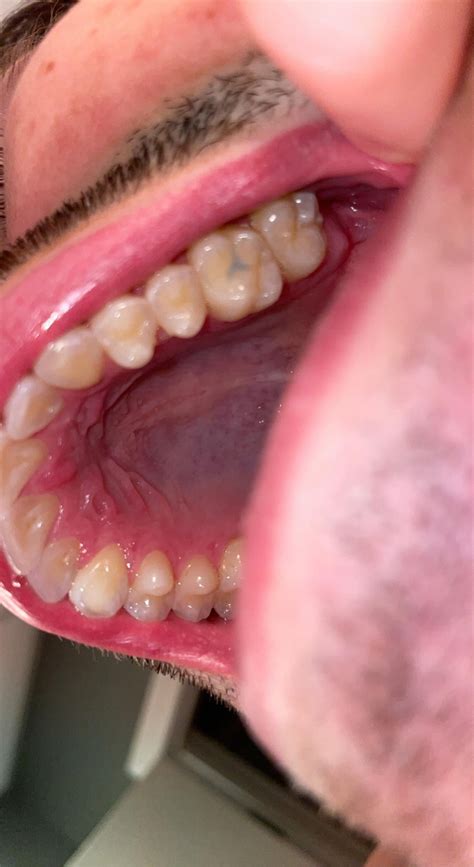 Please Help White Spot On Gums Flat And Smooth Just Like Normal Gums