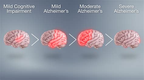 Alzheimers Disease Cancer Quick Facts