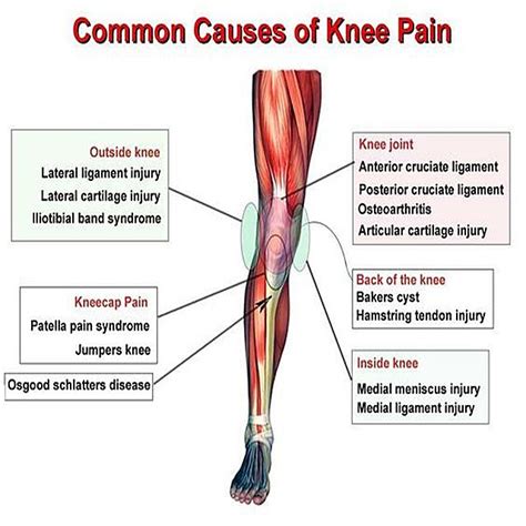 Common Causes Of Knee Pain Kneepain Knee Mdub Mdubmedical