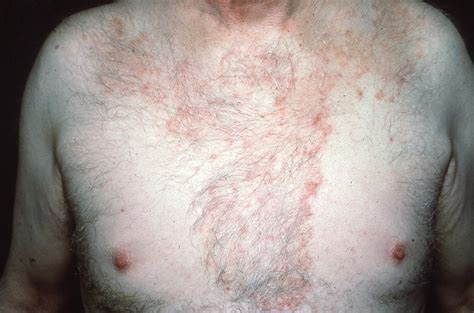 Not All Round Rashes Are Ringworm A Differential Diagnosis Of 2023