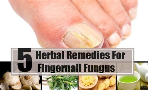 5 Fingernail Fungus Herbal Remedies Natural Treatments And Cure Find