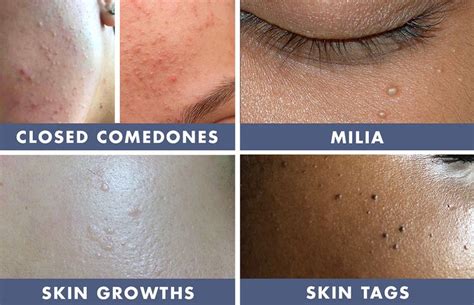 Bumps On The Skin — Age Bumps Skin Growths And Clogged Pores Skin