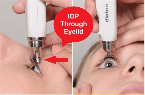 Practice Safe Tonometry Iop Through Eyelid No Contact With Cornea