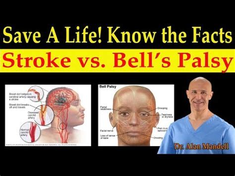 The weakness makes half of your face appear to droop. Save a Life! Know the Facts of Stroke vs. Bell's Palsy ...