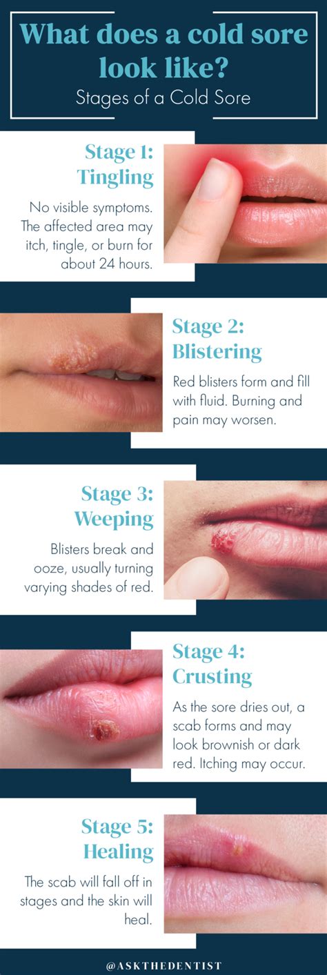 Cold Sores Pictures Symptoms Causes And Treatments