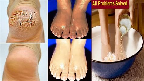 In Just 3 Minutes Get Rid Of Legs Infection Rashes And Cracked Heels