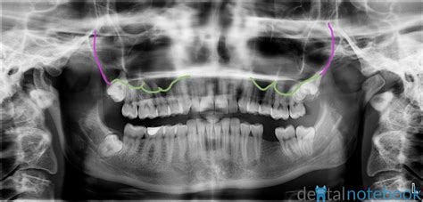 Anatomy Of Panoramic Films Optsdptsopgs Dentalnotebook