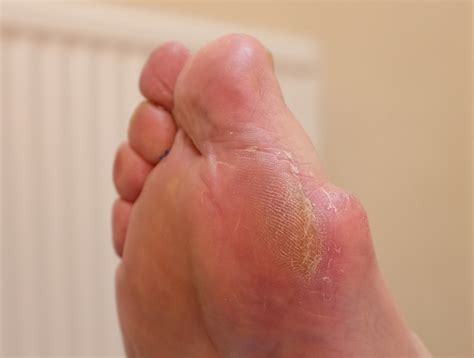 What Causes Dry Rough Skin On The Feet Feel Your Feet Community