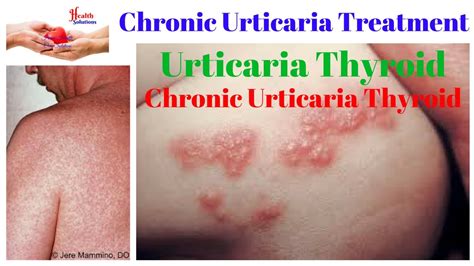 Chronic Urticaria Treatment Urticaria Thyroid Chronic Urticaria