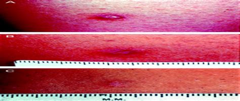 Treatment Of Dermatofibroma With A 600 Nm Pulsed Dye Laser Dermatologic Surgery